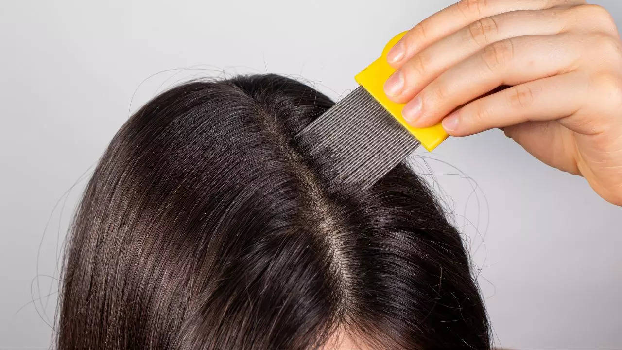 Follow these Effective home remedies to remove lice from your hair -बालों  में लीख और जू की समस्या से हैं परेशान? तुरंत ट्राई करें ये असरदार घरेलू  उपाय| Lifestyle News,Hindi News