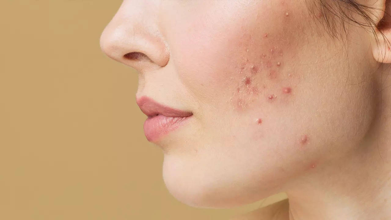Home Remedies for Pimples: फंक्शन में जाने से पहले कर लें पिंपल्स का इलाज, ये घरेलू उपाय करेंगे मदद