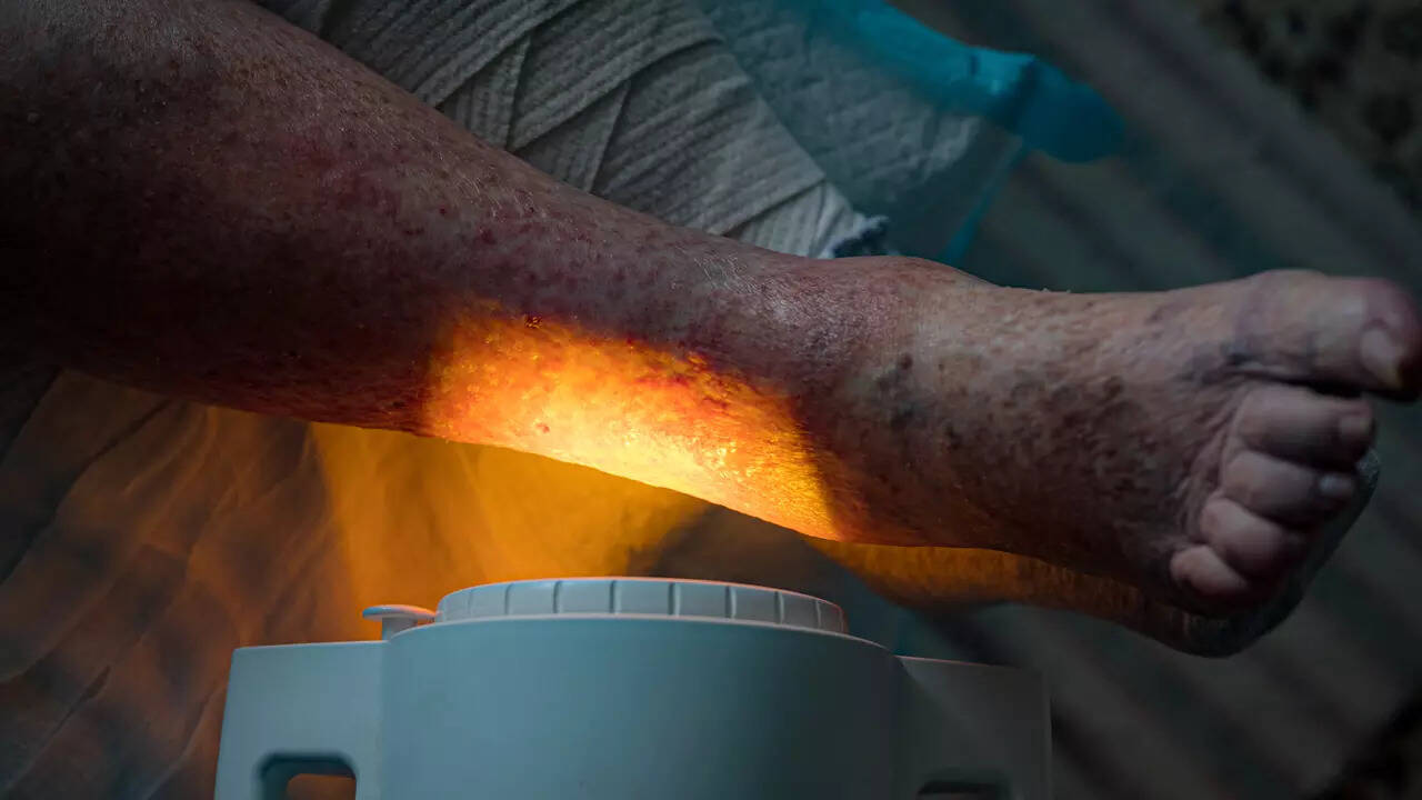 Diabetic Foot Ulcer