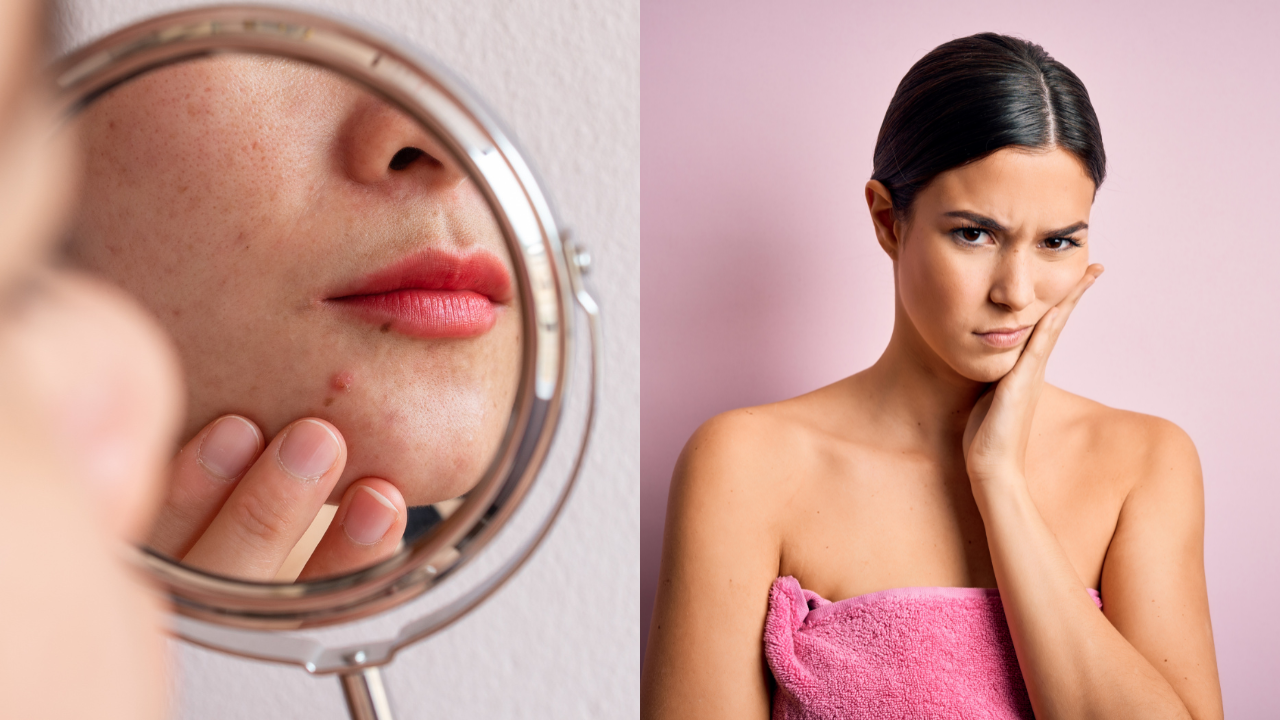 Causes of dull acne skin, Home remedies for facial glow, skin problems