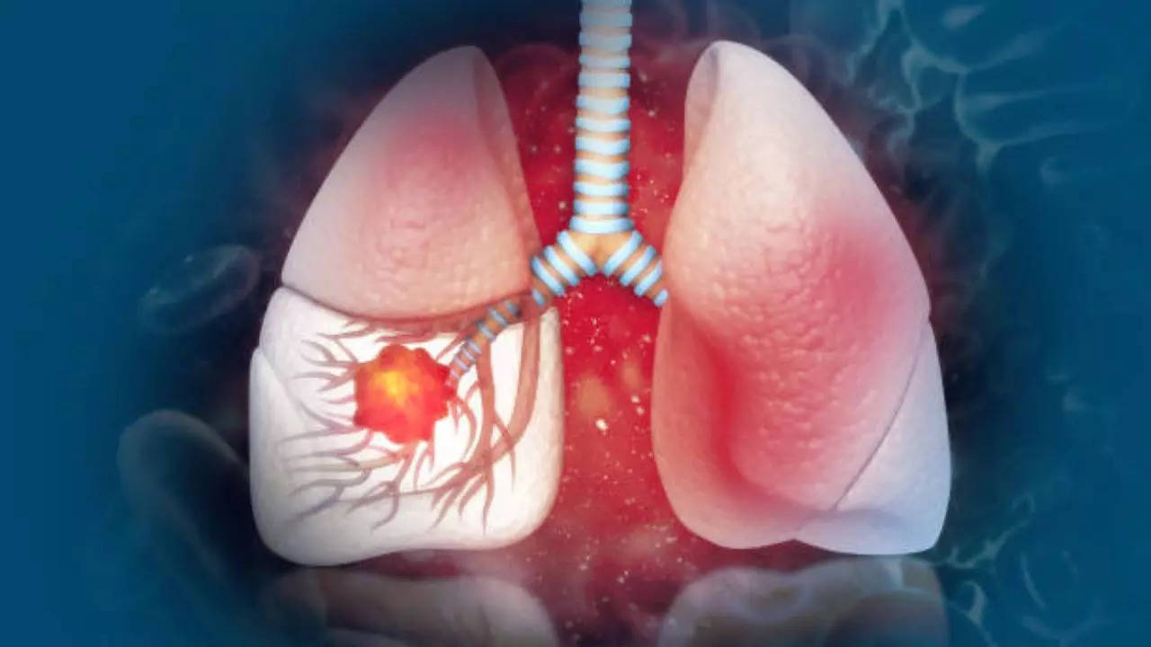 लंग कैंसर की नई दवा का क्लीनिकल ट्रायल सफल