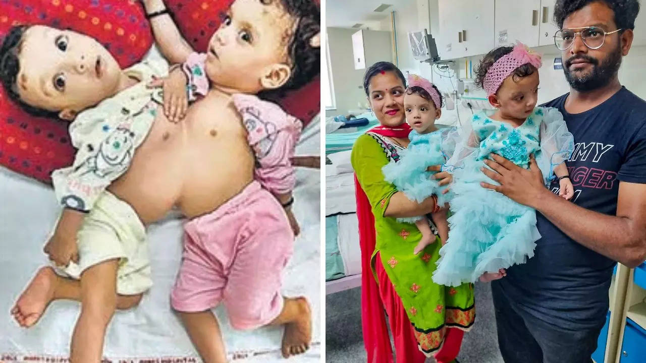 Delhi AIIMS, Conjoined twin girls, Riddhi, Siddhi