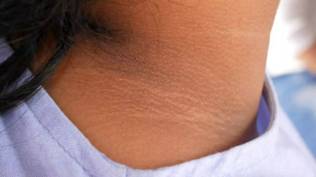 Home remedies to remove black neck