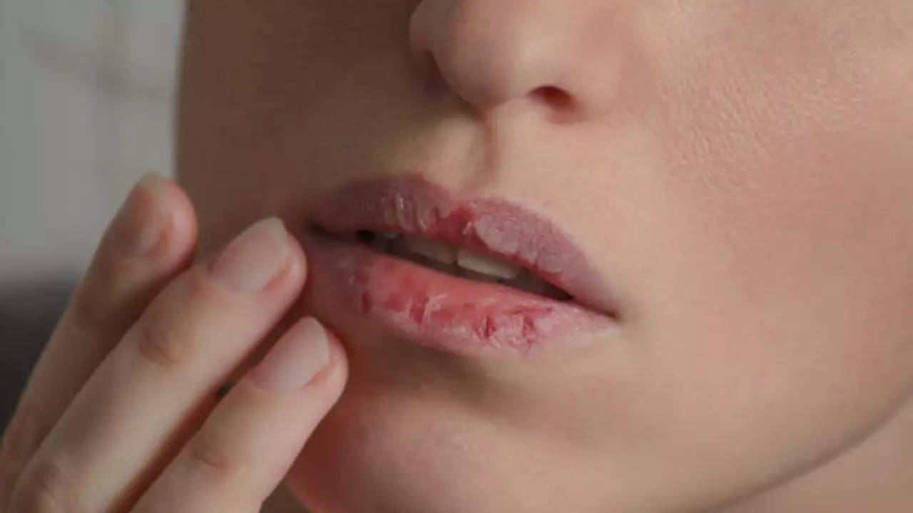 How to get rid of Dry Lips