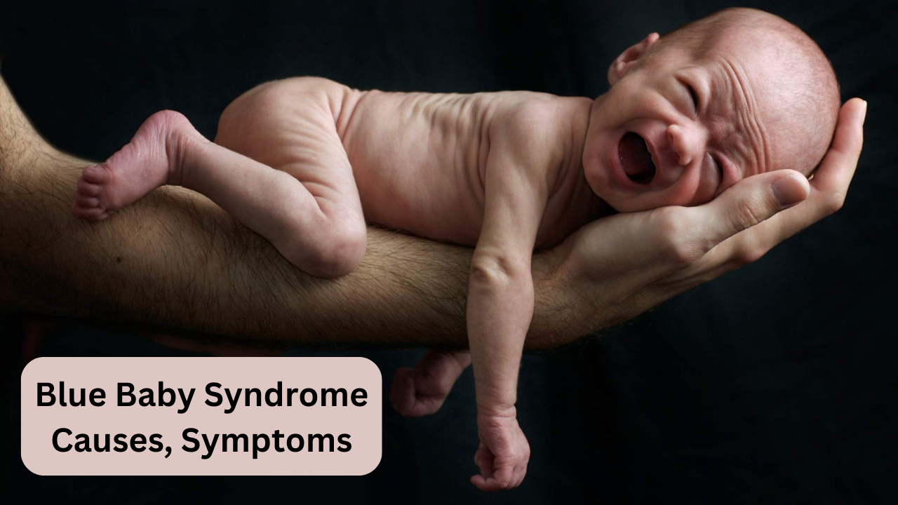 Blue baby syndrome is caused by, blue baby syndrome symptoms, what is blue baby