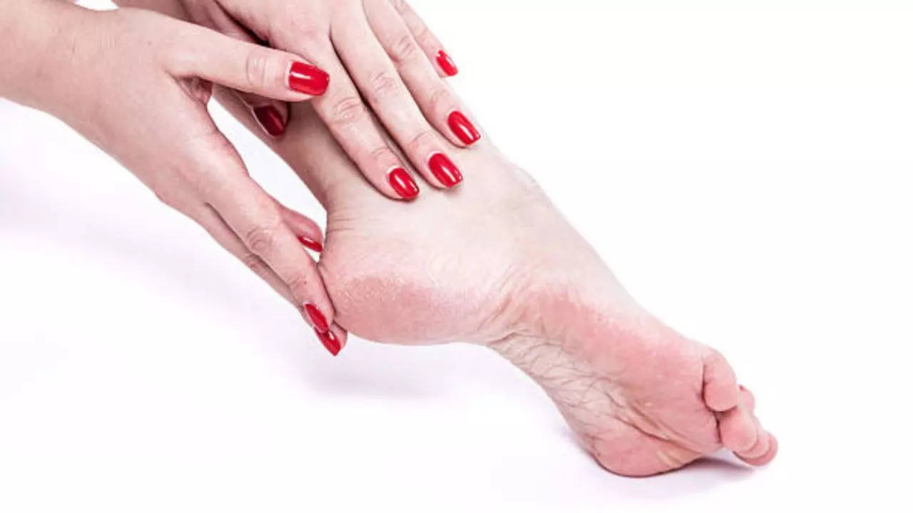 Home remedies for Cracked Heels