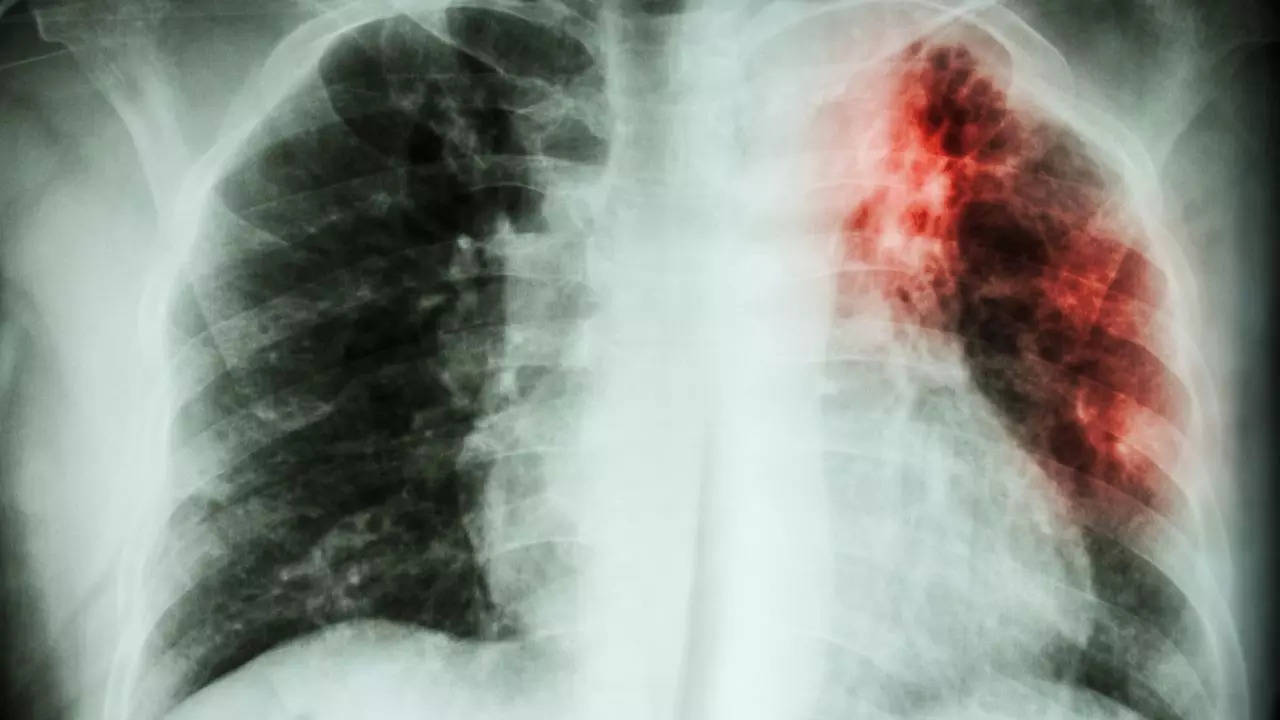 Tuberculosis Cases, TB Cases, world health organization, WHO Report