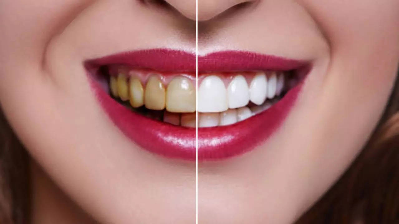 Home remedies for Yellow Teeth (Source:istock)