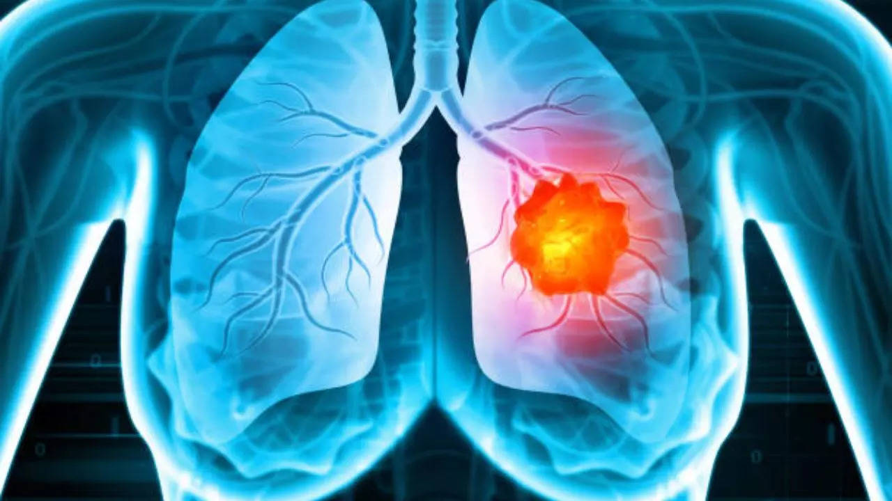 symptoms of lung cancer