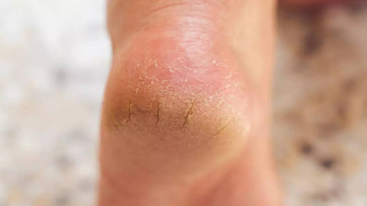 home remedies to get rid of cracked heels