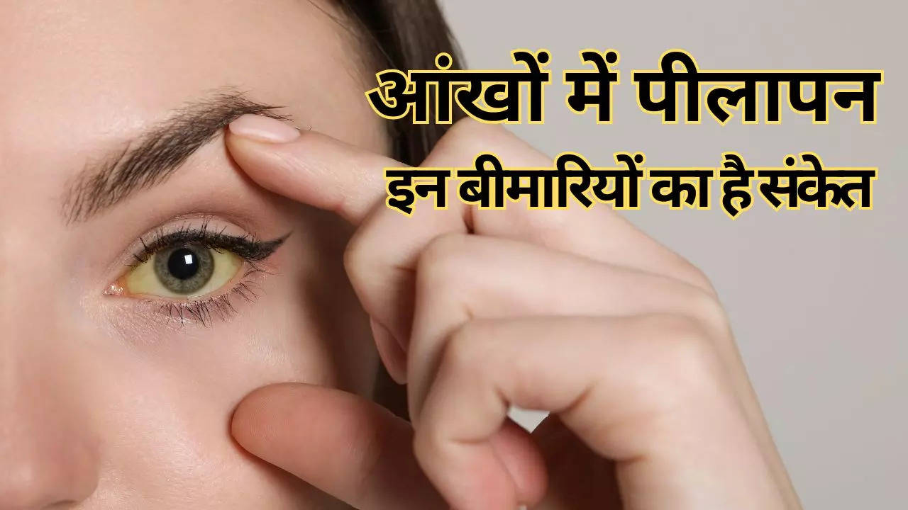 Disease-That-Causes-Yellow-Eyes-In-Hindi