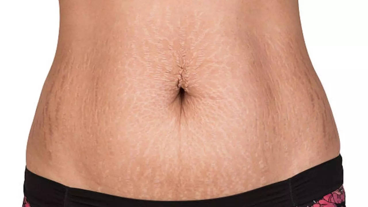 How to get Rid of Stretch Marks