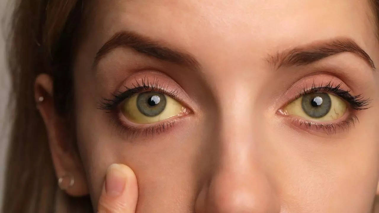 Symptoms Of Vitamin B12 Deficiency In Eyes