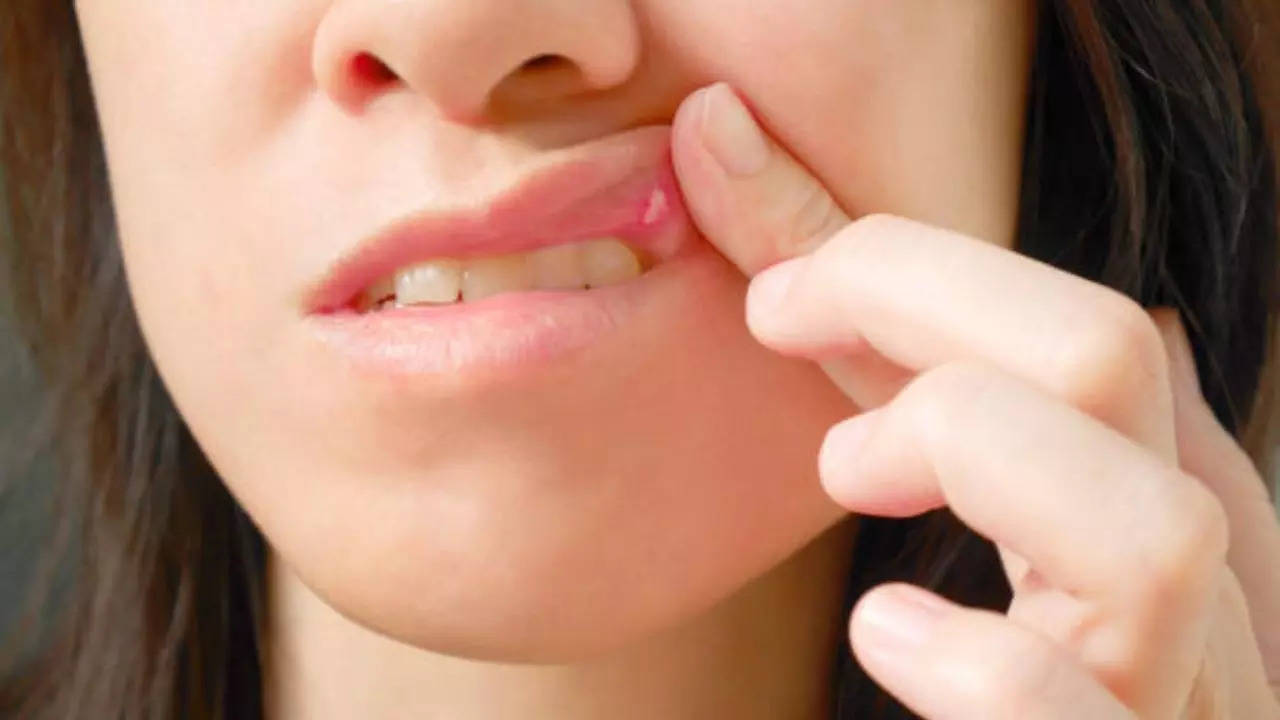 Mouth Ulcers Home Remedies