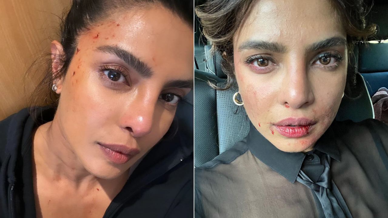 Priyanka Chopra Injury Photos