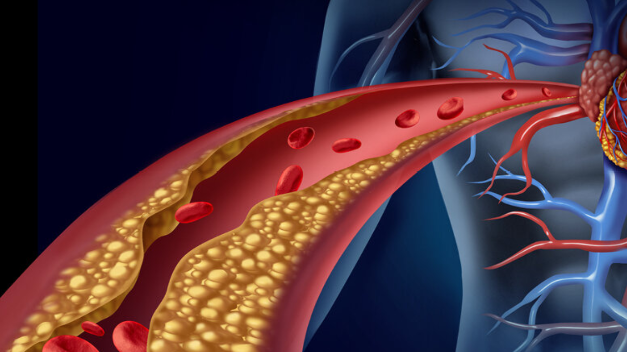 Cholesterol Control, Cholesterol Home Remedies, Bad Cholesterol