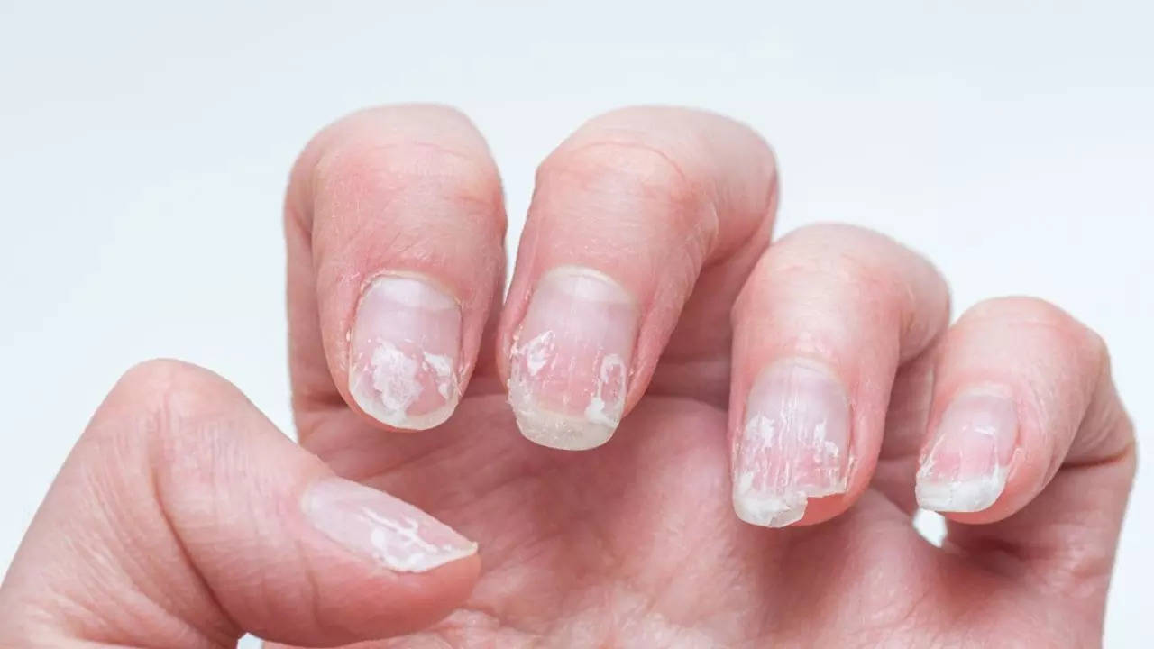 Signs Of Vitamin Deficiency In Nails