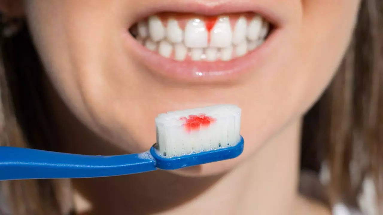 Vitamin Deficiency Causes Bleeding Gums