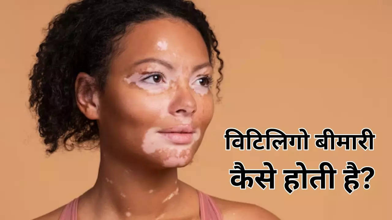 What Causes Vitiligo