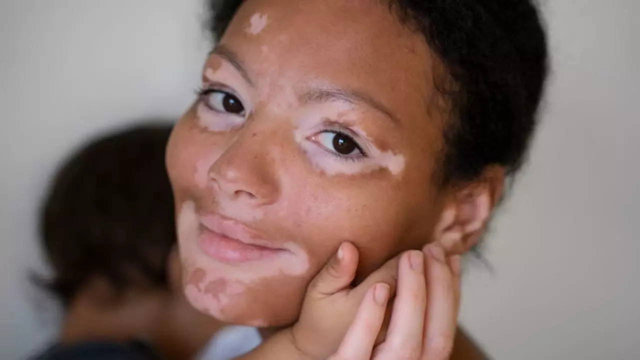 Early Symptoms Of Vitiligo