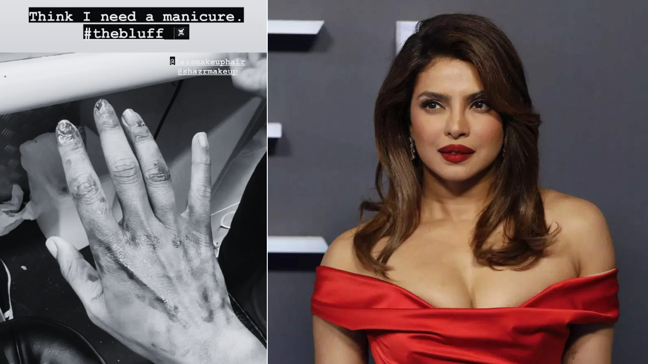 Priyanka Chopra Shows Injured Hand