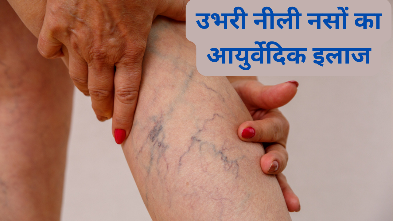 Varicose Veins Ayurvedic Treatment In Hindi