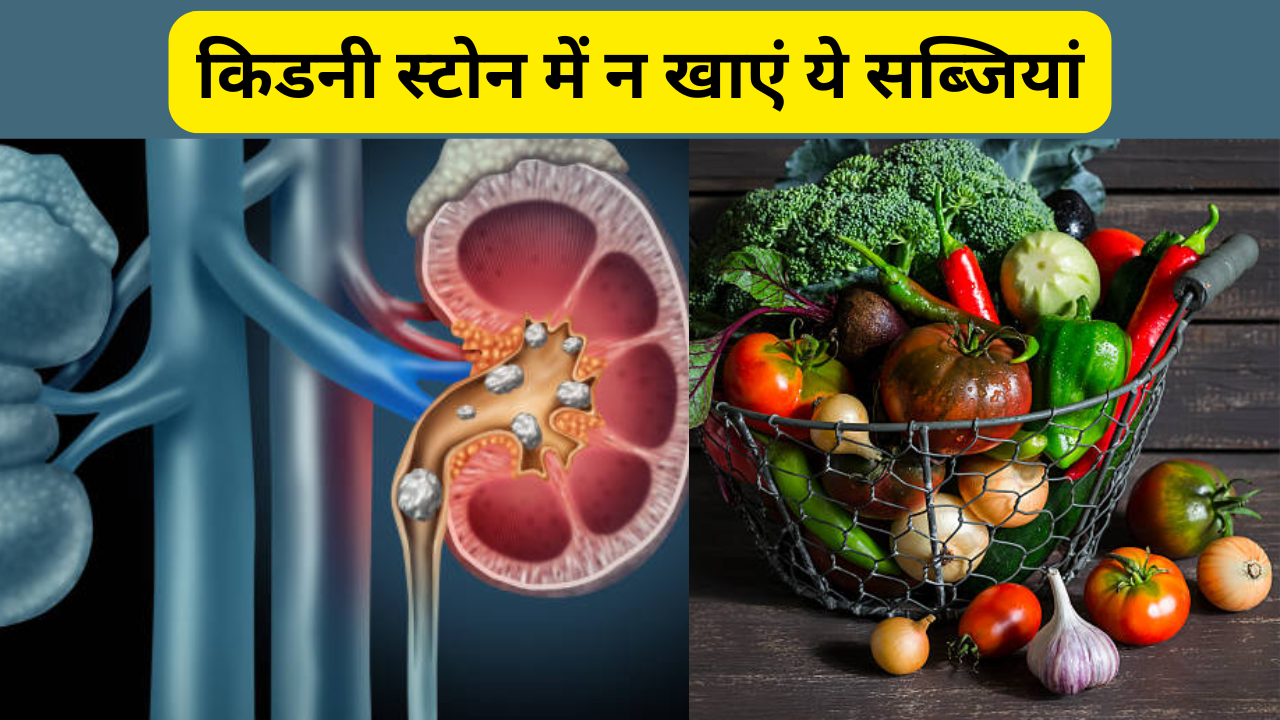 these vegetables are cause of kidney stone eat in limits otherwise you suffer from pain in hindi