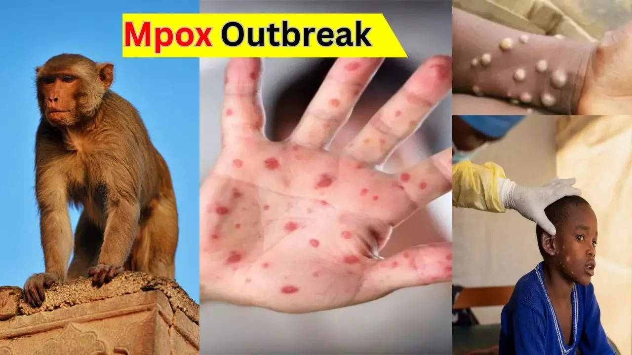 Mpox Outbreak