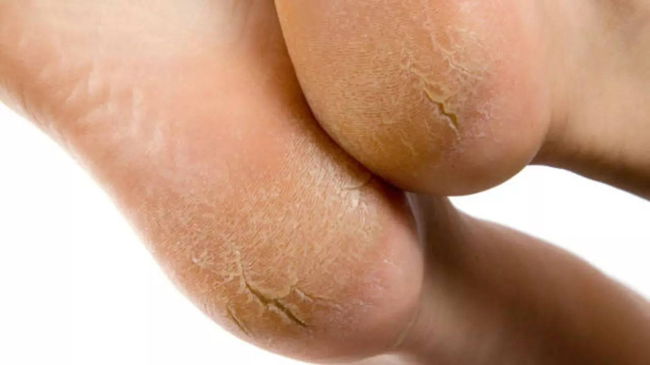 Home Remedies For Cracked Heels