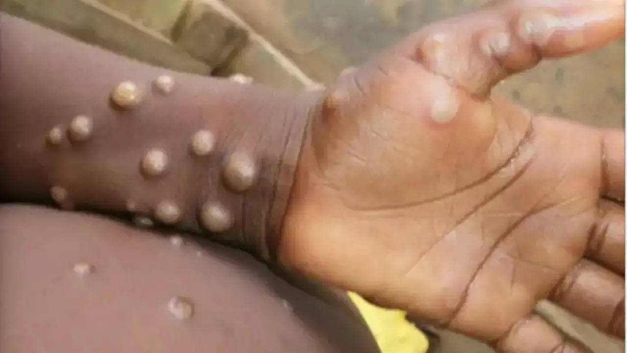 Kerala Mpox Case