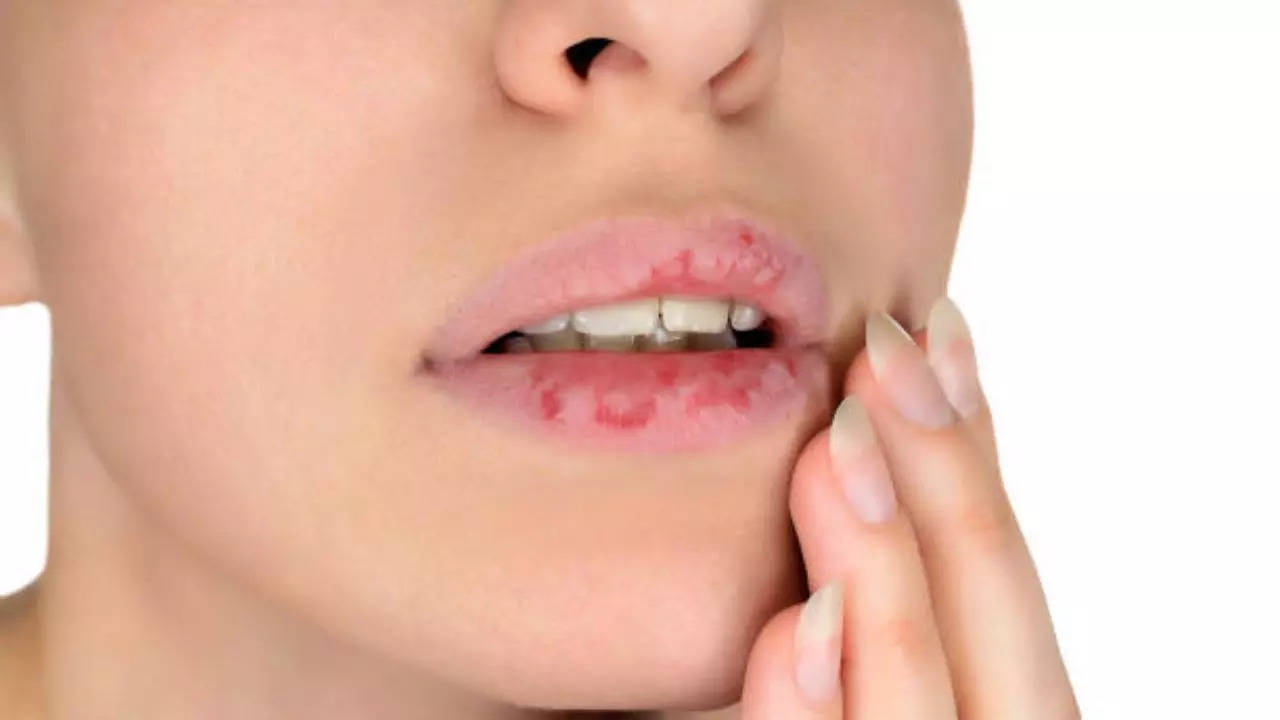 Home Remedies For Dry Lips