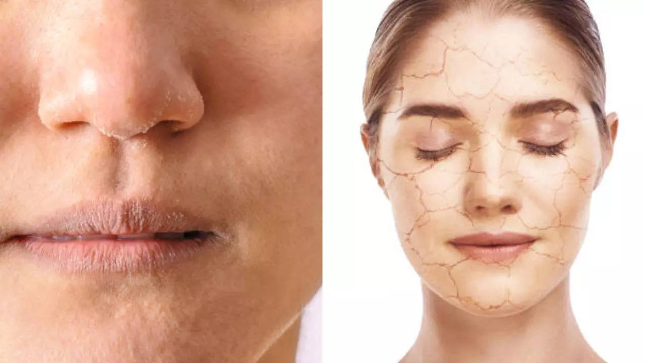 Home remedies to get rid of dry and crack skin