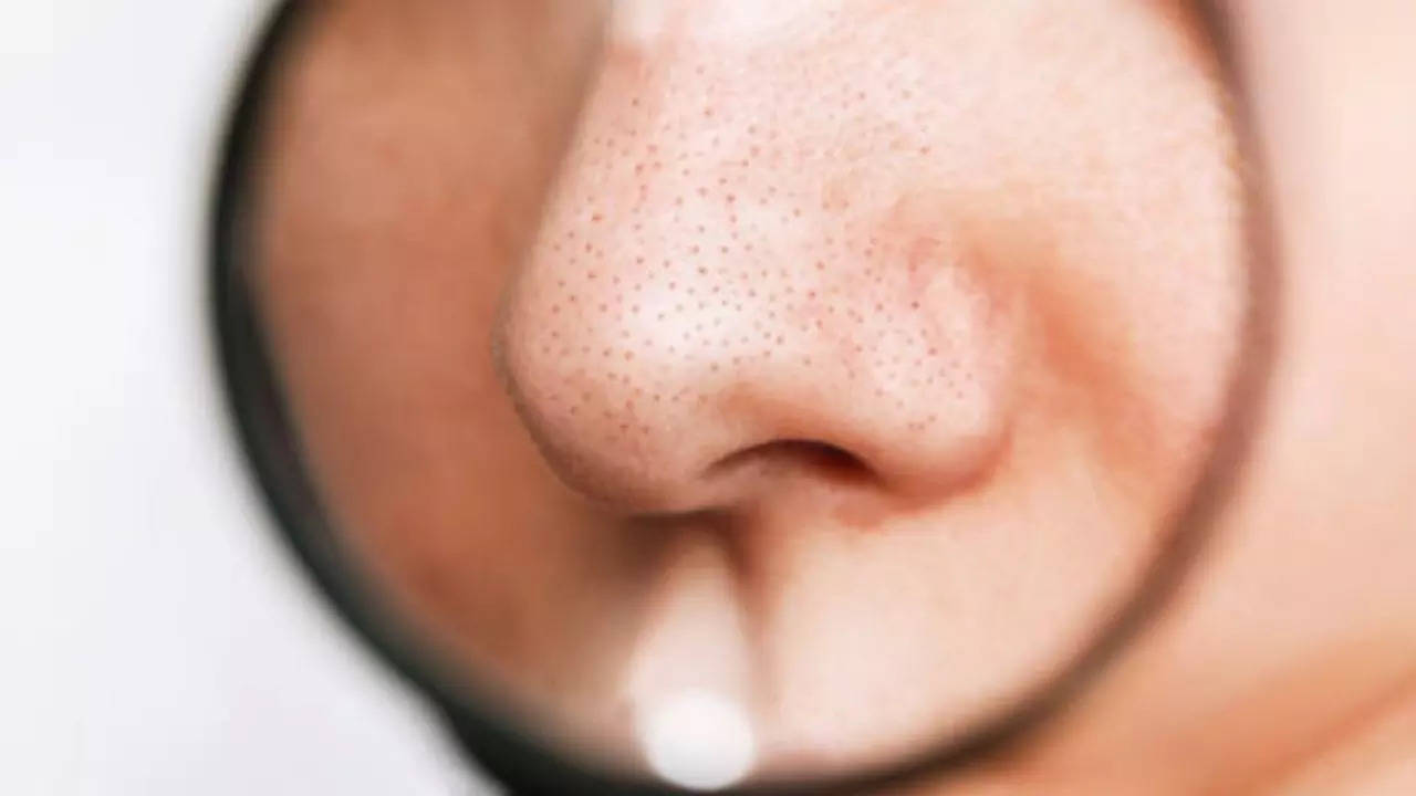 Home Remedies To Remove Blackheads