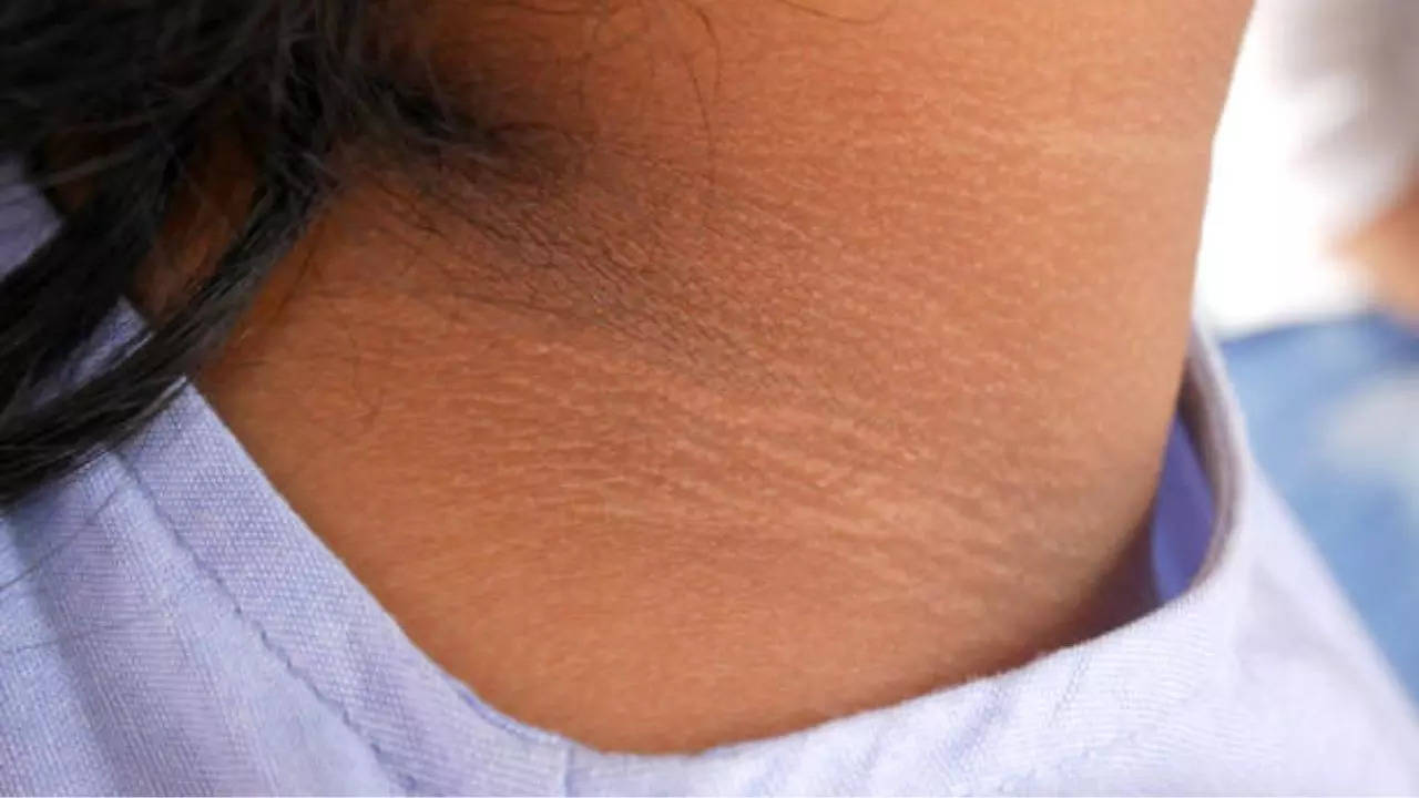 How To Get Rid Of Dark Neck