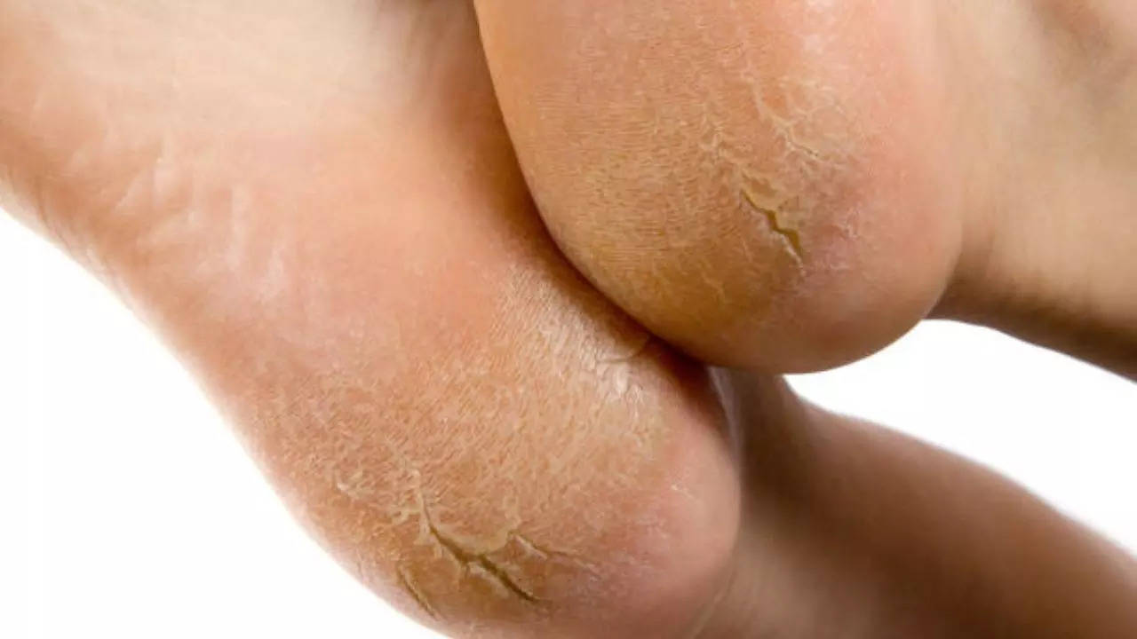 Home Remedies for Cracked Heels in Hindi