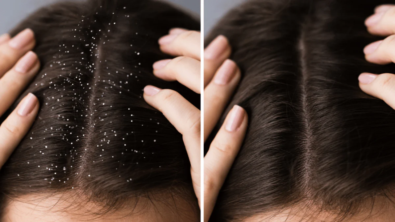 Dandruff home remedies, how to get clean scalp, winter haircare routine