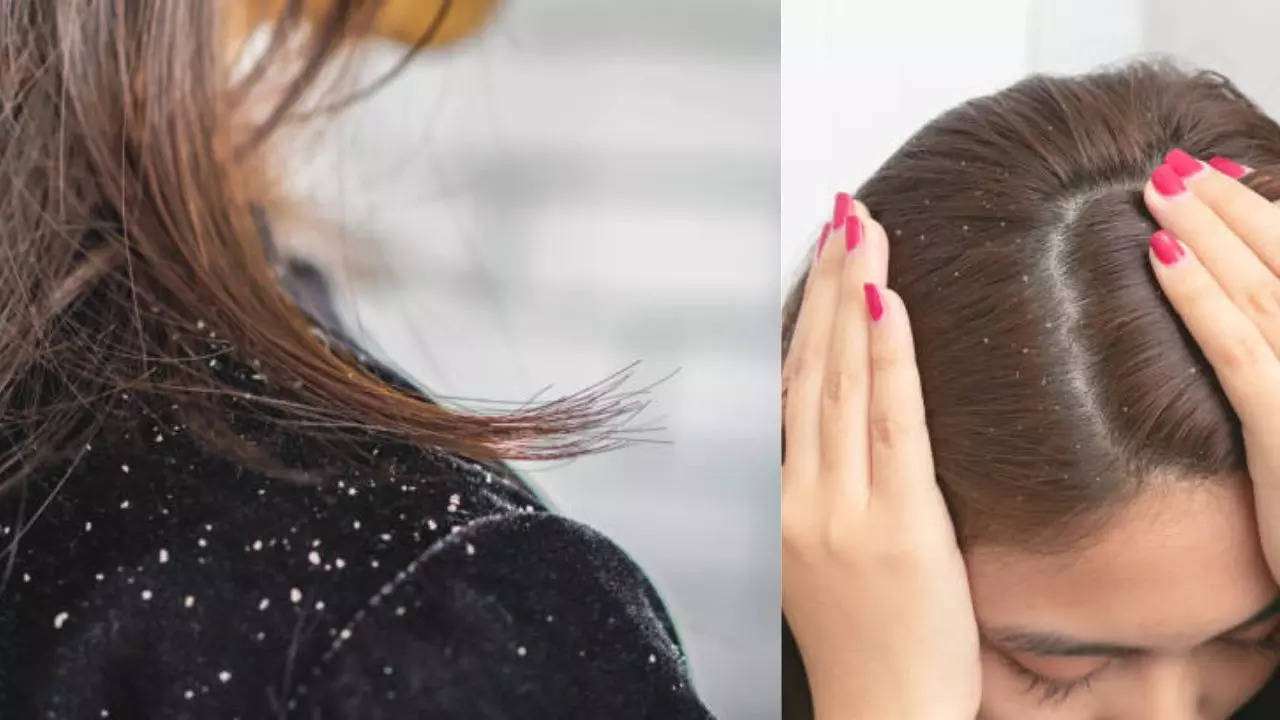 Home Remedies to get rid of Dandruff