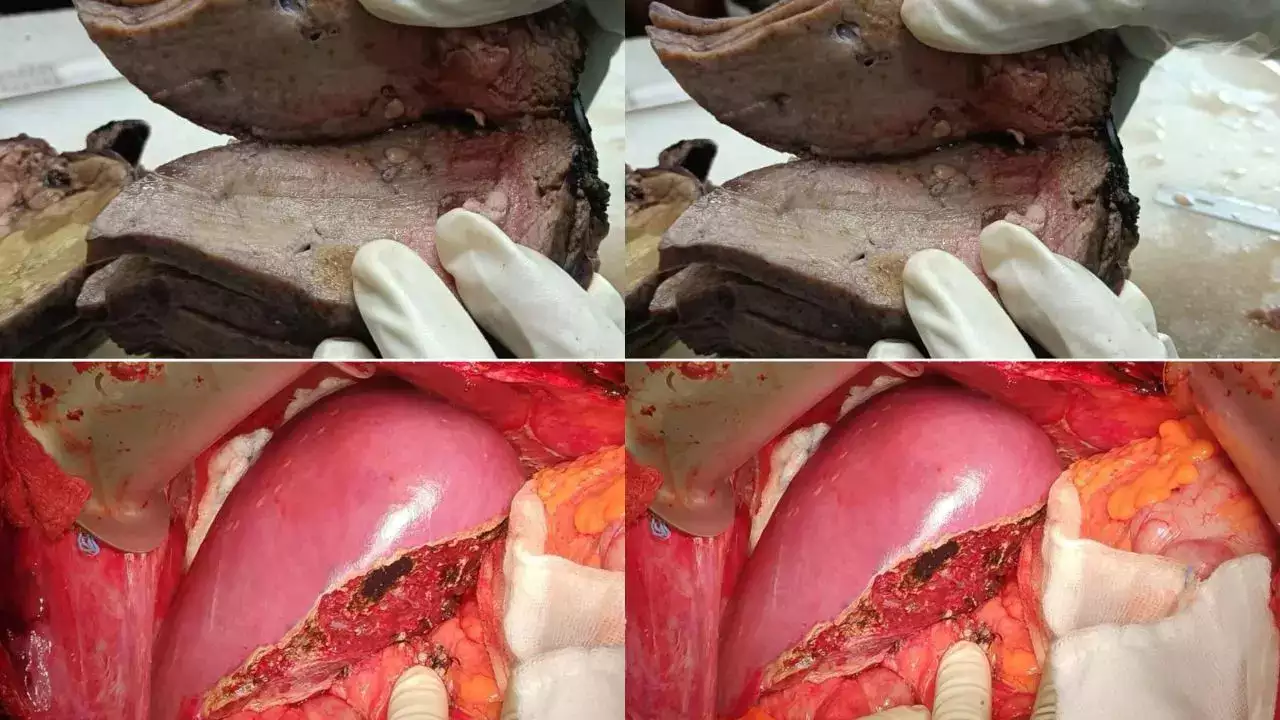 Doctor Shares Picture of healthy Liver and a Weekend Drinker liver