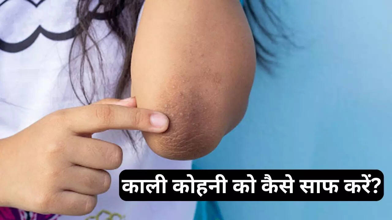 how to get rid of dark elbow overnight at home