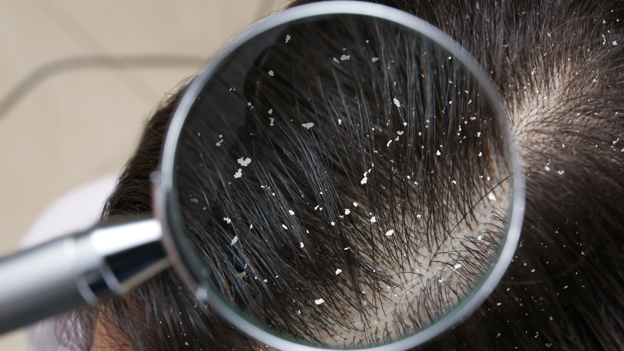 Home remedies for Dandruff, Dandruff kaise door kre, gharelu nuskhe