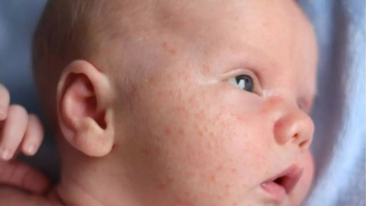 Baby Acne: एक्ने और स्कैल्प पपड़ी जैसे इंफेक्शन से ऐसे करें बच्चों का बचाव, समय पर इलाज है जरूरी