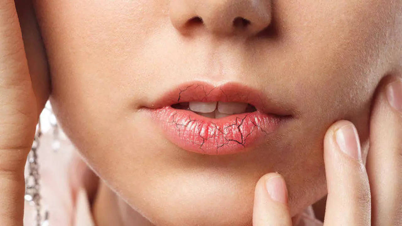 Causes of chapped lips