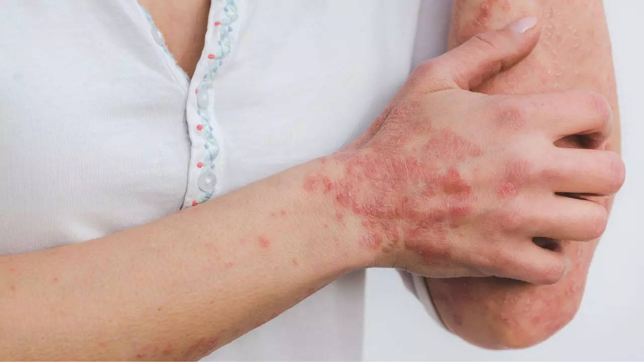 Psoriasis Symptoms