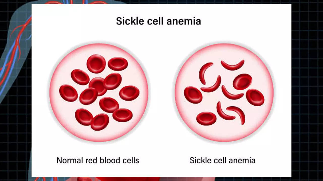 Budget 2023 Modi Government Set A Mission To Eliminate Sickle Cell   97516039 