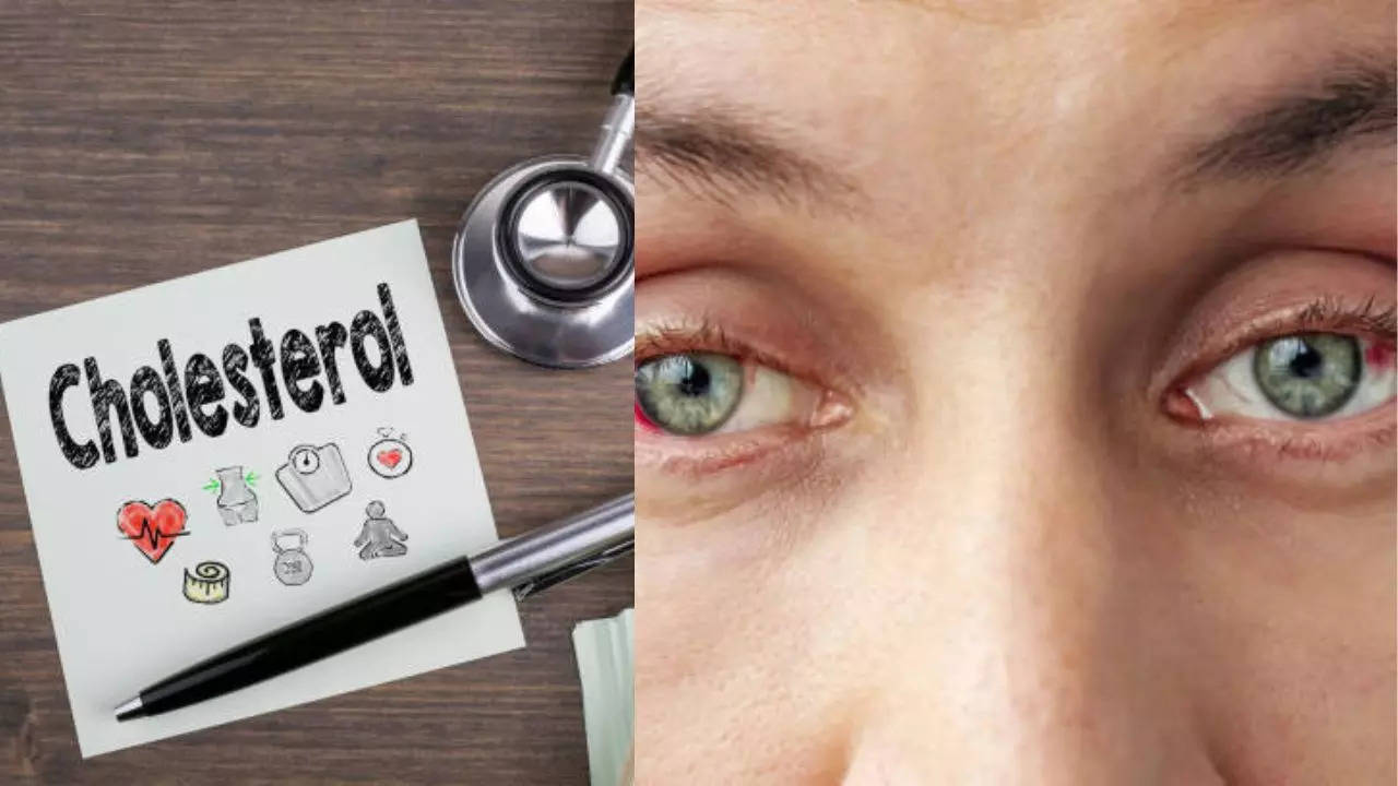 High cholesterol: Warning signs in your eyes you shouldn't ignore