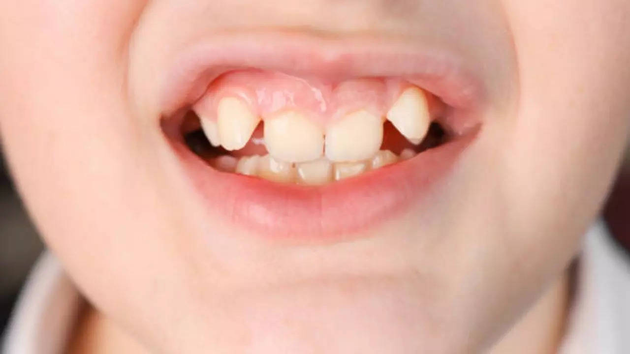 Crooked Teeth, Crooked Teeth Causes, Crooked Teeth Treatment