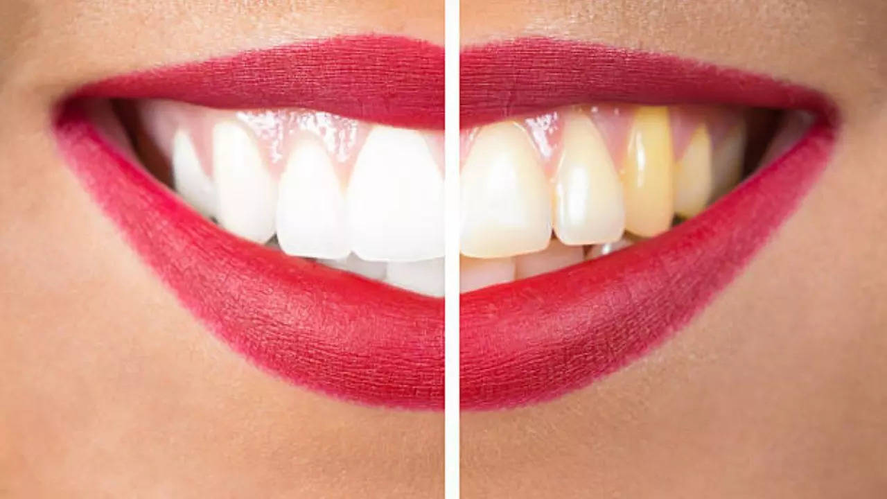 Yellow Teeth, whiten teeth naturally, Food for Teeth Whitening